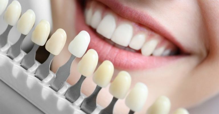 چه عواملی باعث تغییر رنگ دندان های من می شود؟