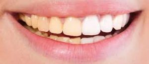 چه عواملی باعث تغییر رنگ دندان های من می شود؟