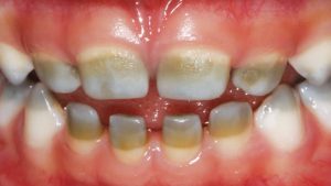 علت سبز شدن دندان ها و نحوه درمان آنها