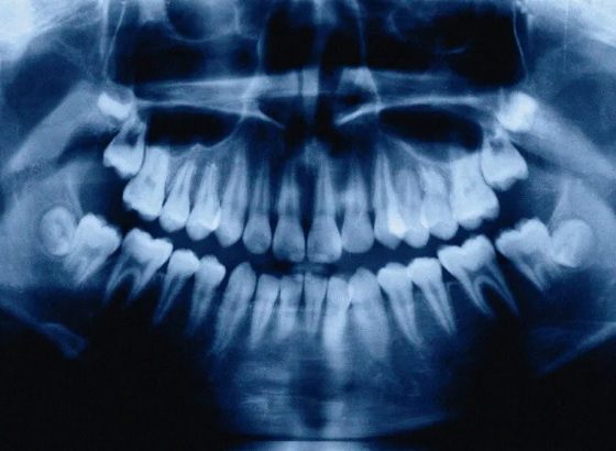 آنچه در مورد کمبود کلسیم و دندان باید بدانید