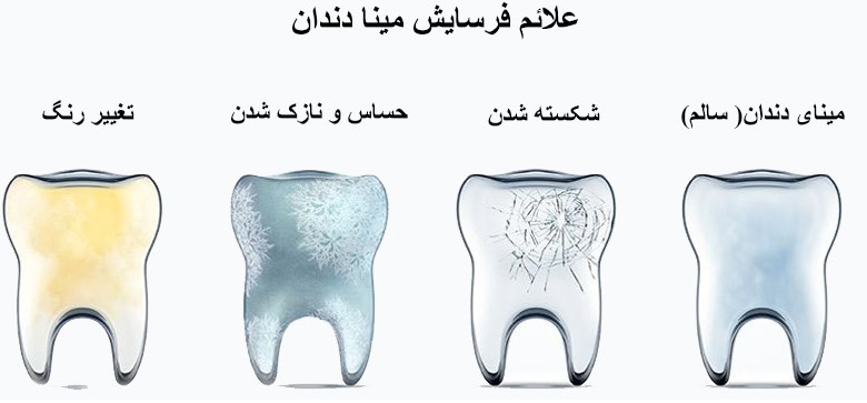 مراحل فرسایش مینای دندان